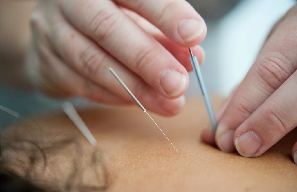 Acupuncture for TMJ. Someone getting acupuncture on their back